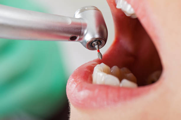 Best Emergency Wisdom Teeth Removal in Normandy Park, WA